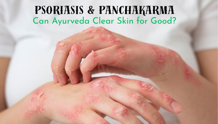 Psoriasis and Panchakarma: Can Ayurveda Clear Skin for Good?
